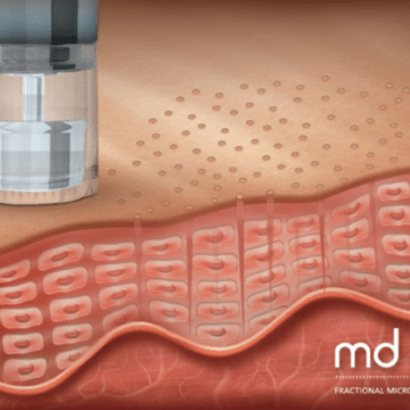 Collagen Induction Microneedling at S.Corbin Esthetics in Waller, TX